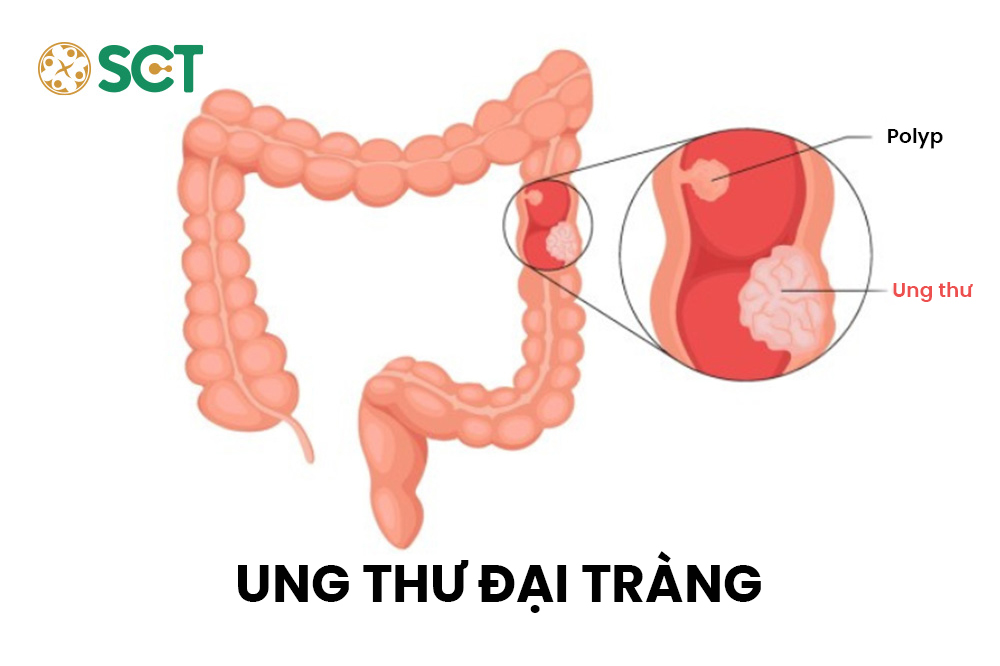 8 dấu hiệu cảnh báo sớm Ung Thư Đại Tràng