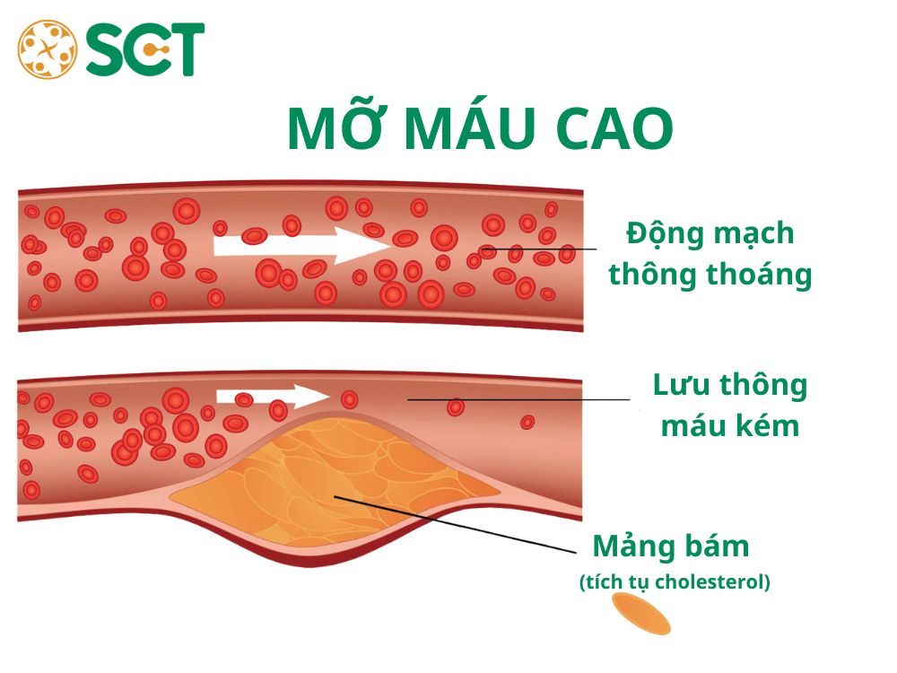 Mỡ Máu Cao: Nguyên nhân, dấu hiệu, cách điều trị và phòng ngừa hiệu quả