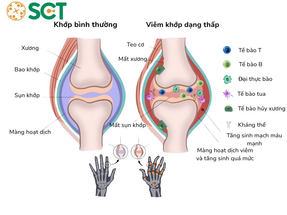 So sánh viêm khớp dạng thấp và khớp bình thường
